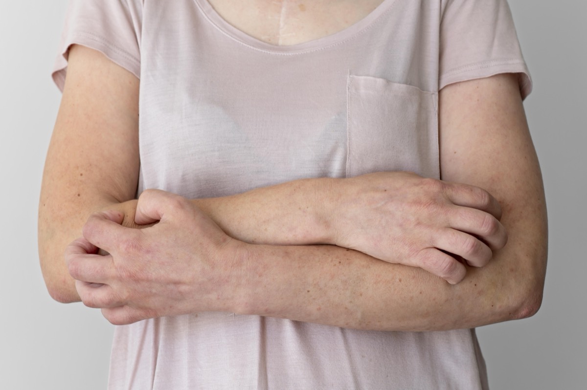 Geröteter Arm mit Quaddeln – Symptome einer Sonnenallergie im Urlaub