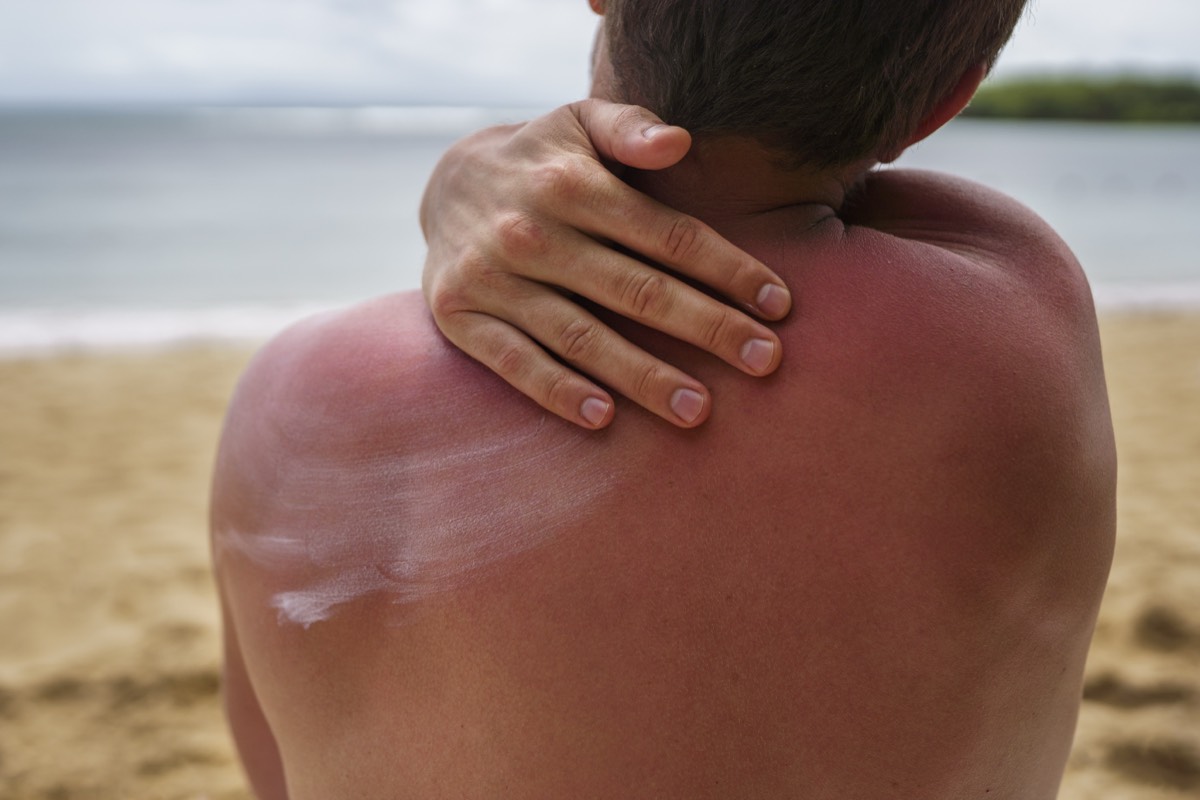 Rücken mit Sonnenbrand – rote Schultern nach einem Tag am Strand auf Lanzarote